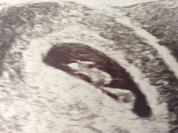 pregnancy symptoms gone