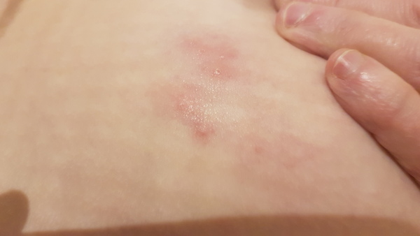 Shingles?