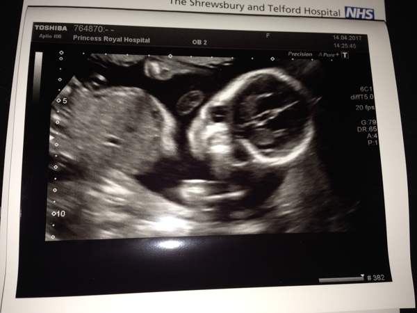 Scan photo question - which side was your baby's head on?