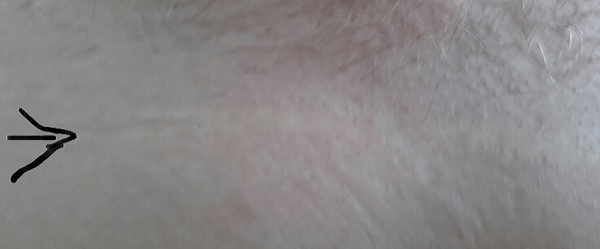 C section scar
