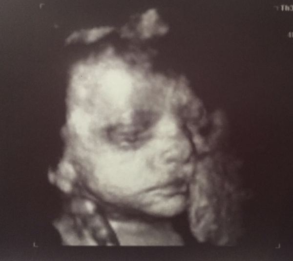 Due July 2017 #4 …… Well into 2nd Trimester! 20 Week Scans and Bumps Galore