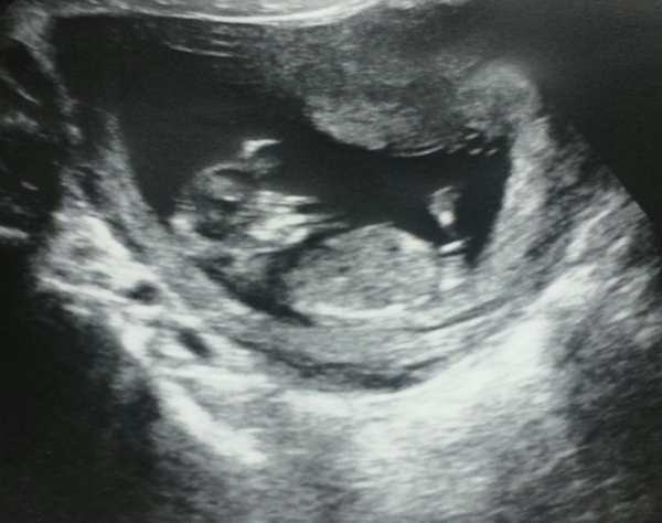 PMA Express to BFP Thread #5