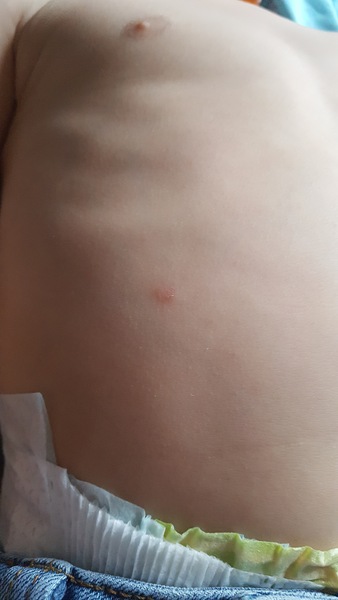 Ds has woken up with a spot on his tummy is this the start of chicken pox? (Pic included)