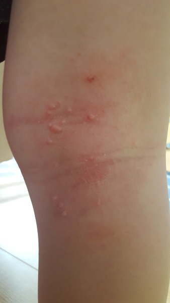 Lumps on DS's inner knee