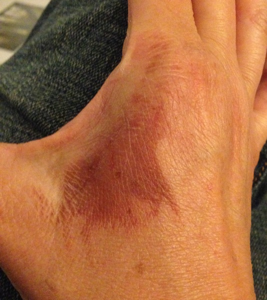 Burnt my hand roasting spuds - is this healing ok? (pic)