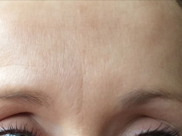 Hideous close up of my face and Botox questio !