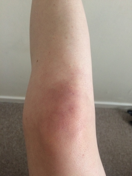 PLEASE help me rid of my red knees once and for all?!!!
