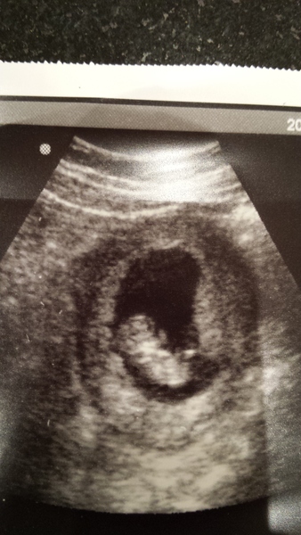 Talk to me about early scans