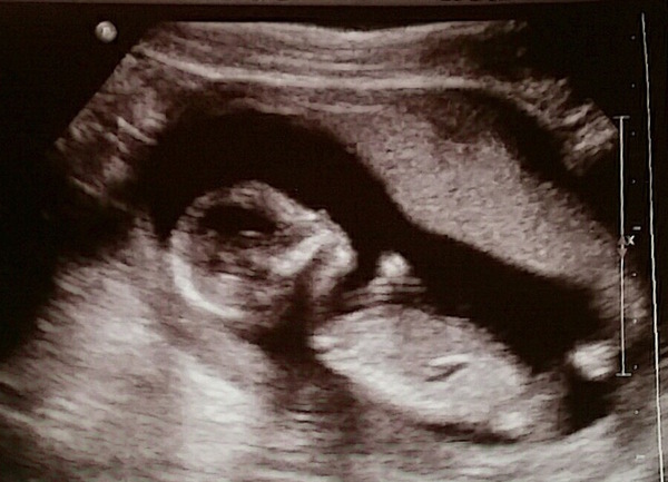14 Week Scan - Boy or Girl?