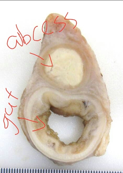 I thought it was a blackhead but it was...