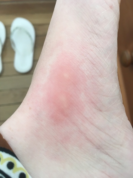 Bites