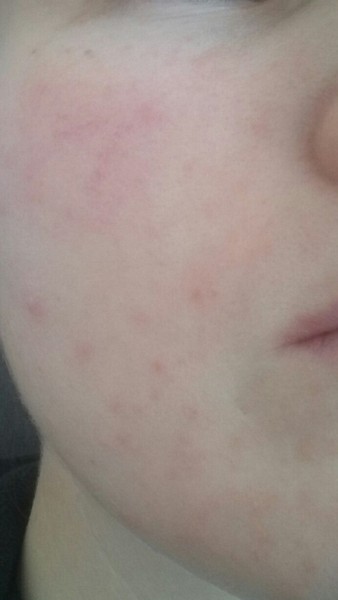 Rosehip oil? Something for redness? Help!