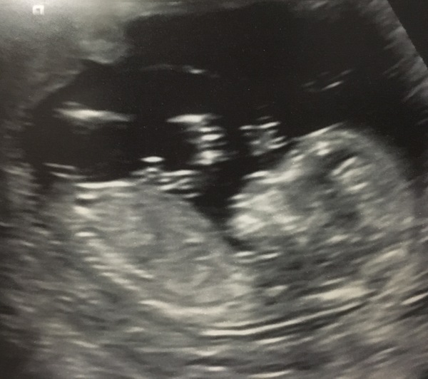 October Babies No. 3