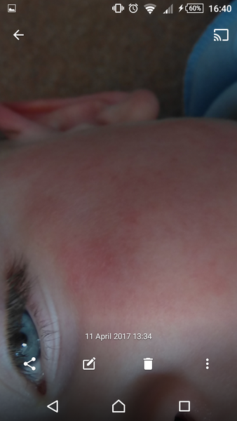 Rash on 3 year old cheek