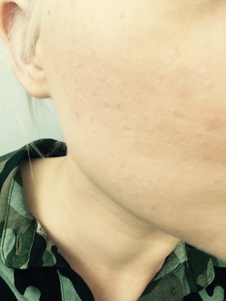 Sick of acne (warning with pics) what to ask for at GP