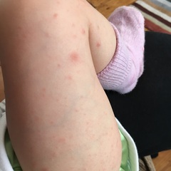 ...to ask you if this is what you think chicken pox looks like?