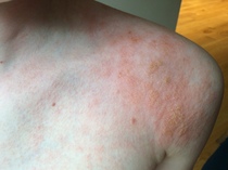 Rash getting worse...allergy? Eczema? Virus? Photo to help!