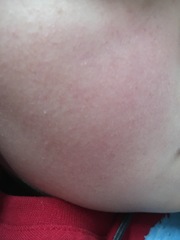Temperature, dizziness and now rash on face (with pic)