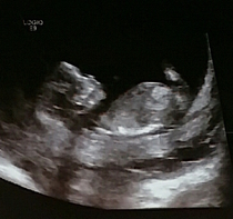 14 Week Scan - Boy or Girl?