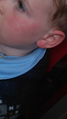 Rash on 3 year old cheek