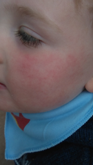 Rash on 3 year old cheek