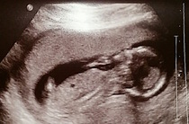 14 Week Scan - Boy or Girl?