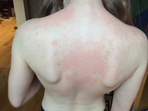 Rash getting worse...allergy? Eczema? Virus? Photo to help!