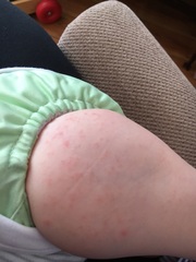 ...to ask you if this is what you think chicken pox looks like?