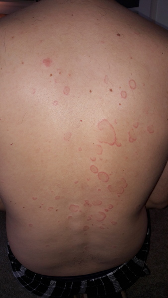 husband has odd rash on his back - pic included