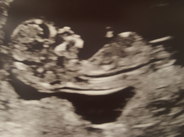 12 week vs 20 week scan