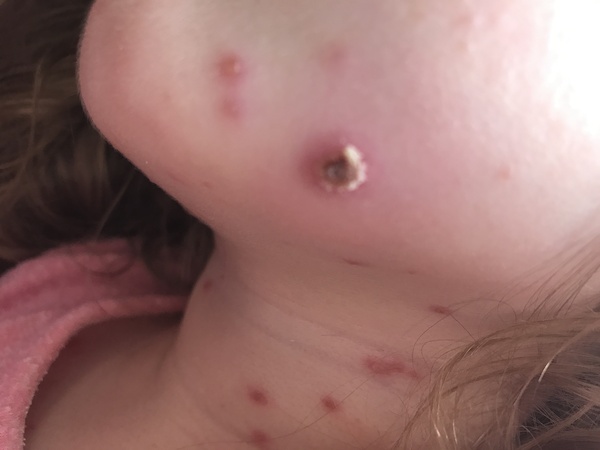 Infected chicken pox?