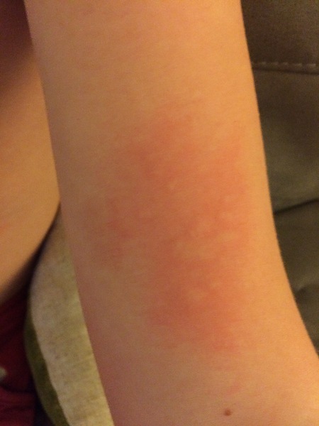 Rash after handling GPs-please help!