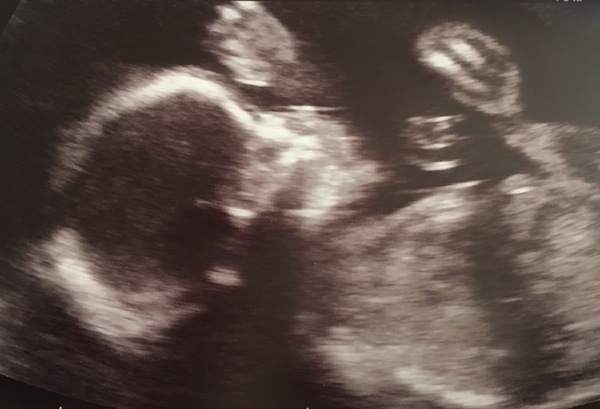 Hyperemesis Support