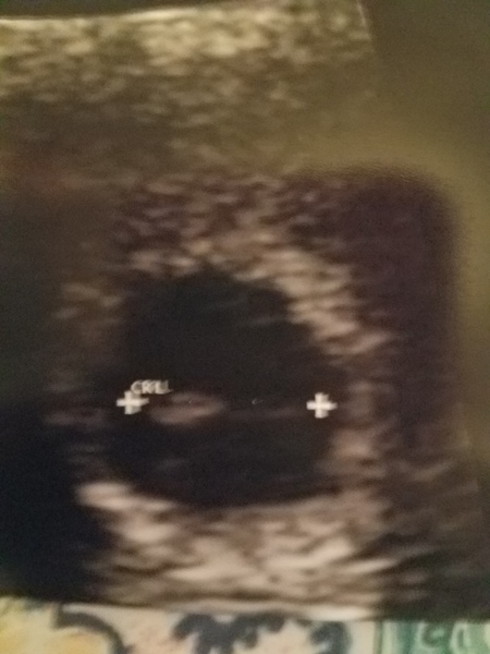 Grab your scans ladies for the...drumroll...Ramzi Placenta Theory!