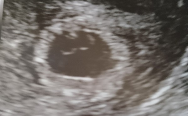 Possible twin pregnancy help needed? (scan pic attached)