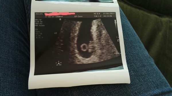 Confused about dates / measurements - pics of scan attached!