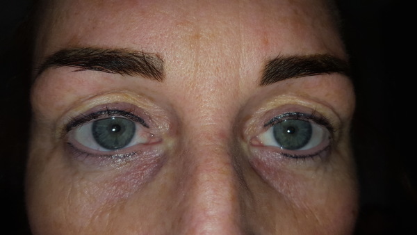 Plexr eye treatment