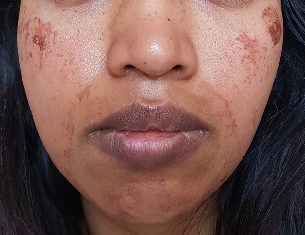 Horribly ripped skin during a Professional facial wax, please help! Pics attached.