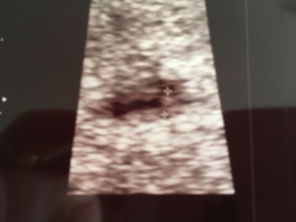 January 2018 babies - early scans and midwife appointments!