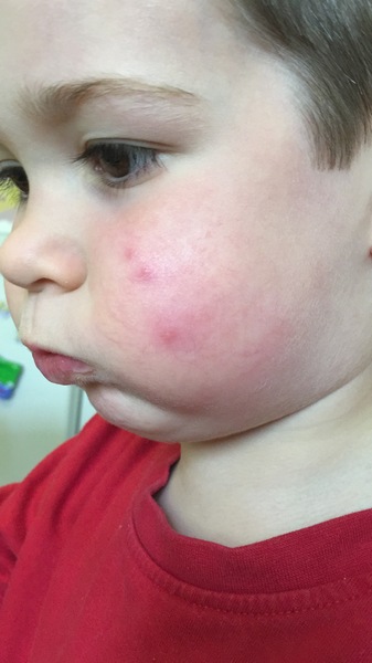 Could this be chicken pox? (Pics)