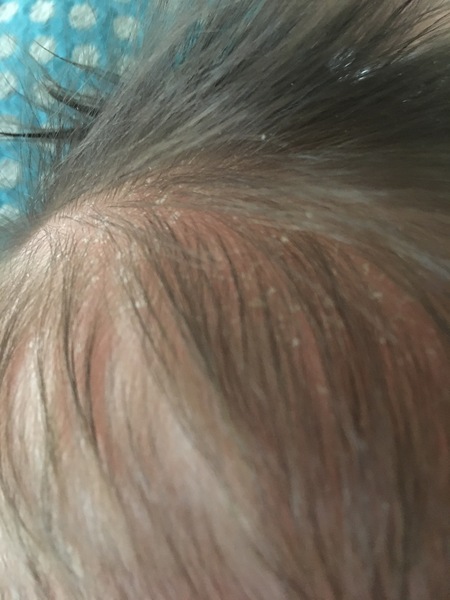 Dry scalp but lots of hair!