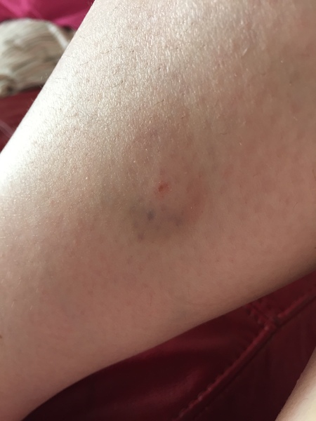 Have i been bitten?