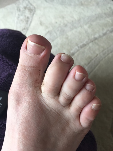 Anyone want to see my manky toe?