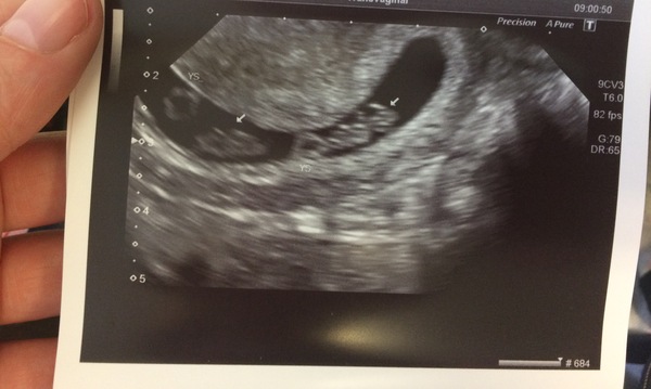 8 week scan tomorrow morning, what to expect???