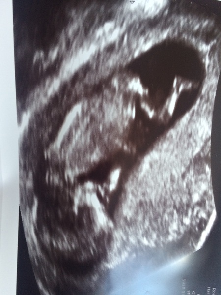 December 2017 babies #5 - dating scans and food chat, and dwindling symptoms???