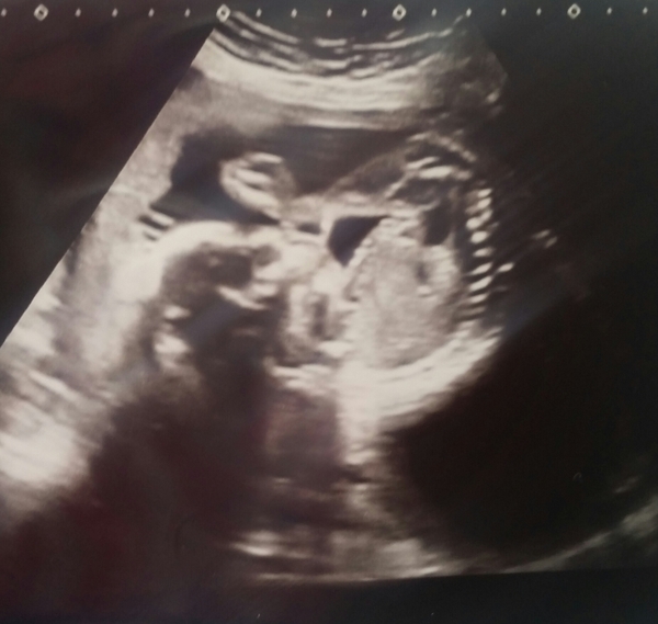 Hyperemesis Support