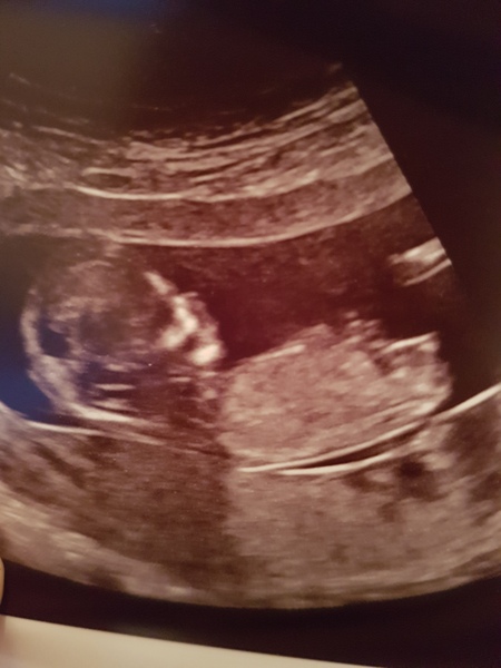 Boy or girl guesses? 12 + 5 scan photo