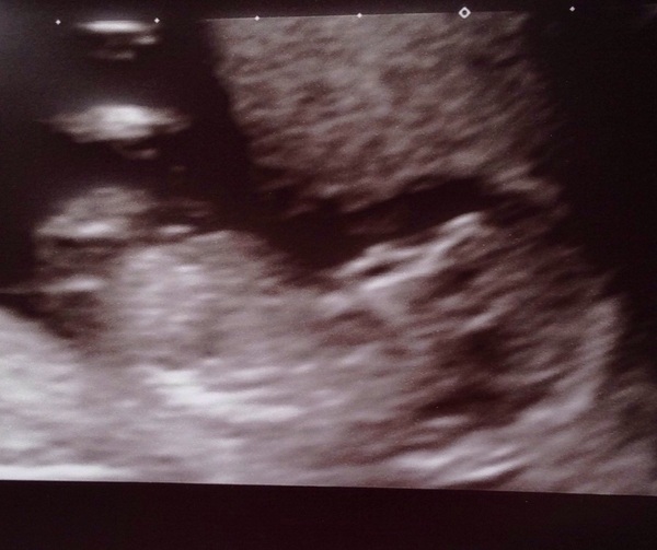 #makeithappen TTC through Donor IUI or Donor IVF or just undecided. All welcome. Thread 8