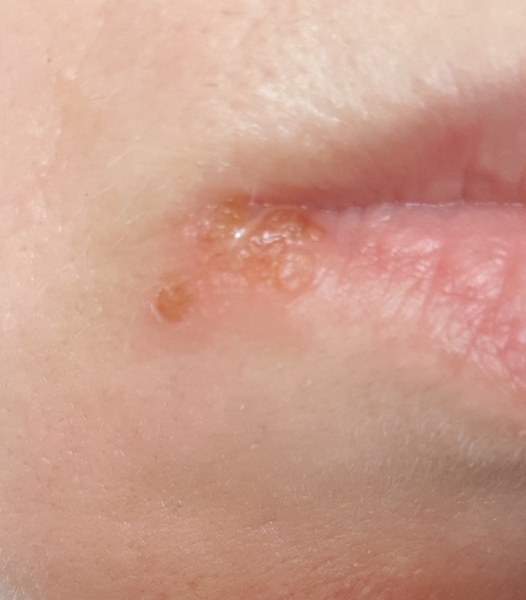Is it the lurgy?