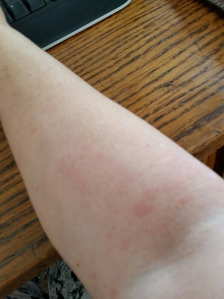 to ask you to diagnose my rash??